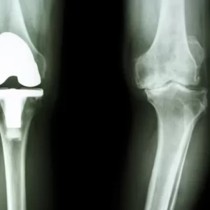 knee X-ray is a medical imaging procedure