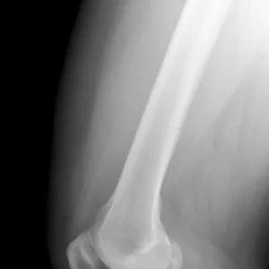 femur X-ray is a medical imaging procedure