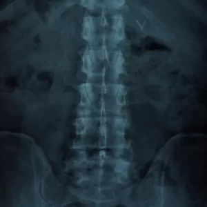 Diagnosis of a pelvic fracture