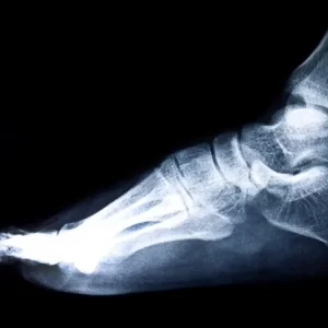 calcaneus fracture, also known as a heel fracture